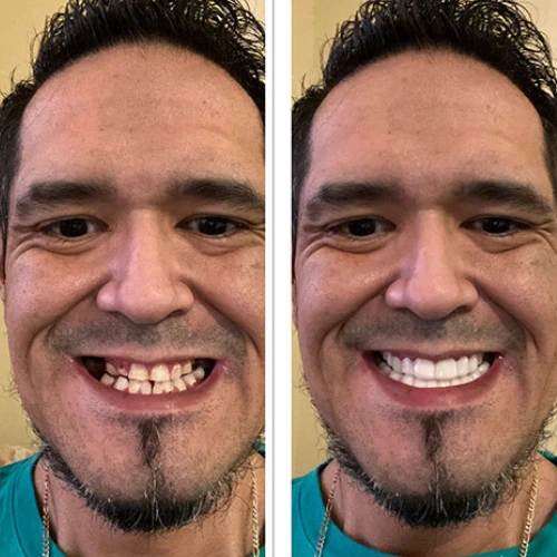guy before vs after trying SwiftSmile on